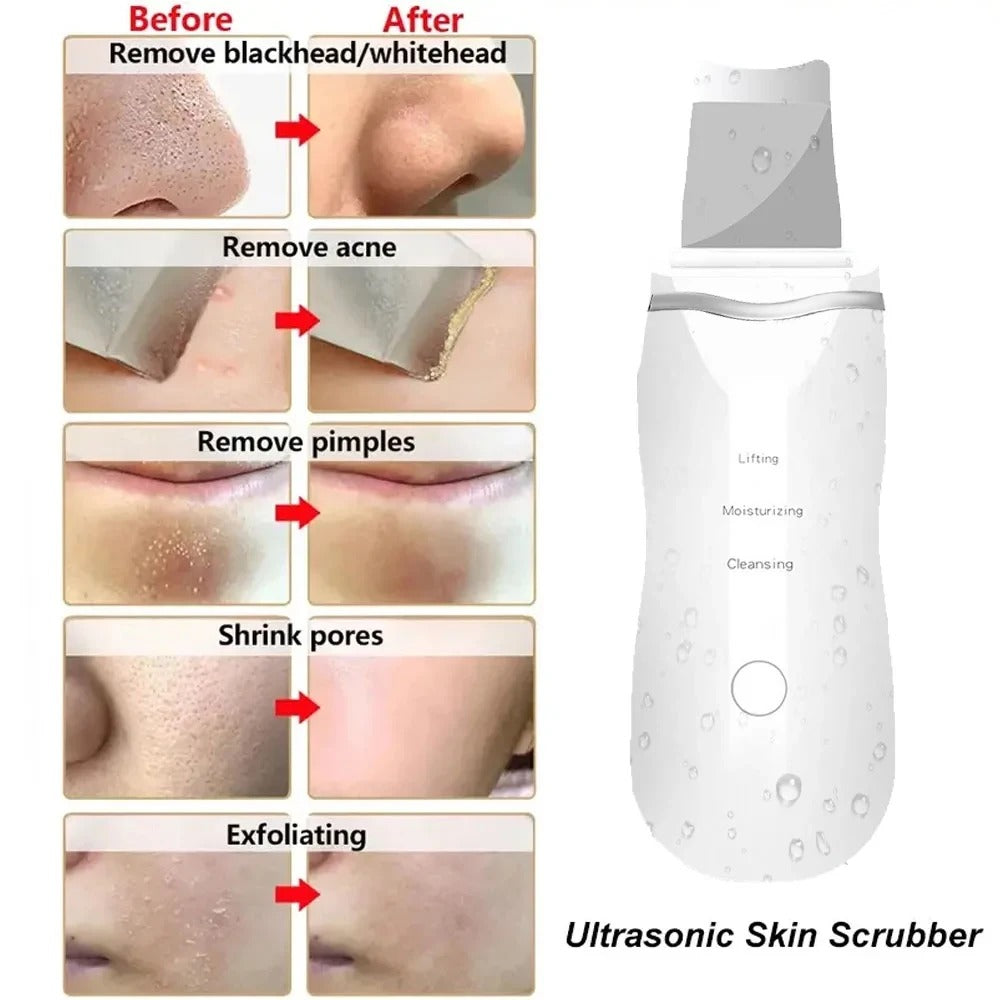 Ultrasonic Skin Scrubber Blackhead Remover